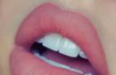 Hyaluronik asit ile dudak büyütme sonrasında neden şişlik oluştu, dudak büyütme sonrası dudakların iyileşmesi ne kadar sürer?