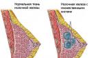 Leczenie adenozy gruczołu sutkowego metodami ludowymi Jak leczyć adenozy gruczołu sutkowego środkami ludowymi